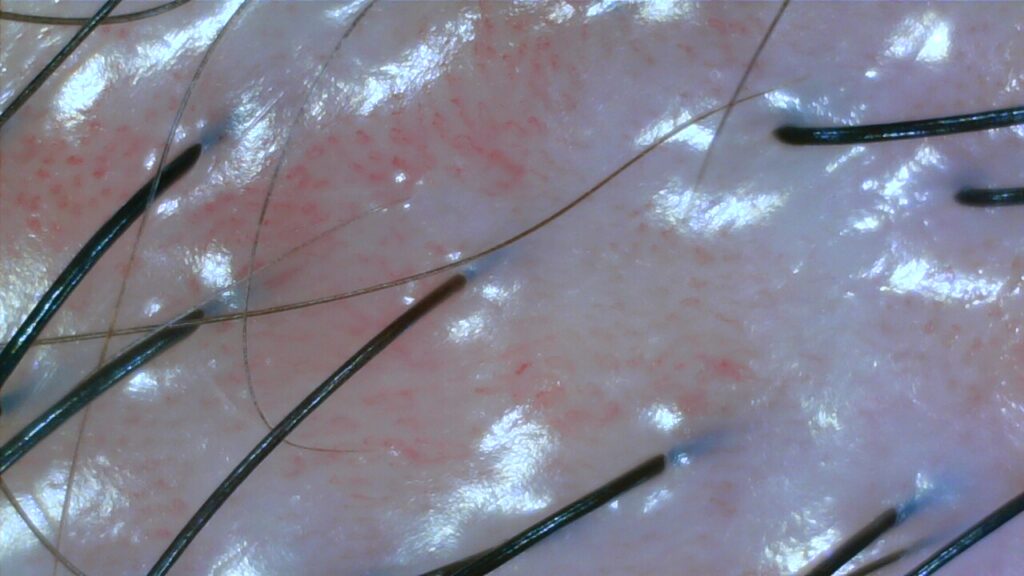 Dandruff scalp after treatment at NŌMI
