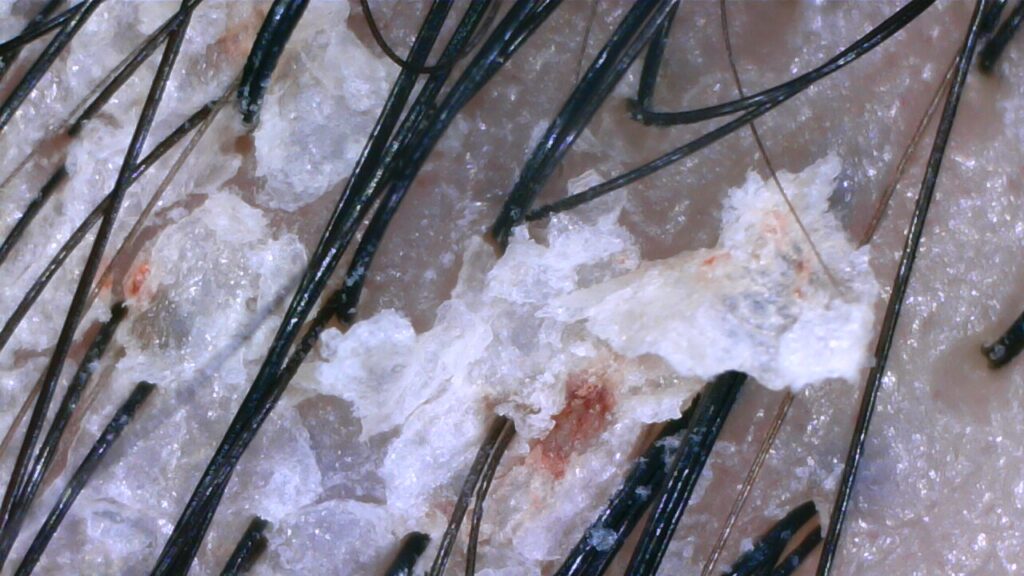 Dandruff scalp before treatment at NŌMI