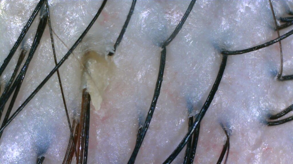 Oily scalp before