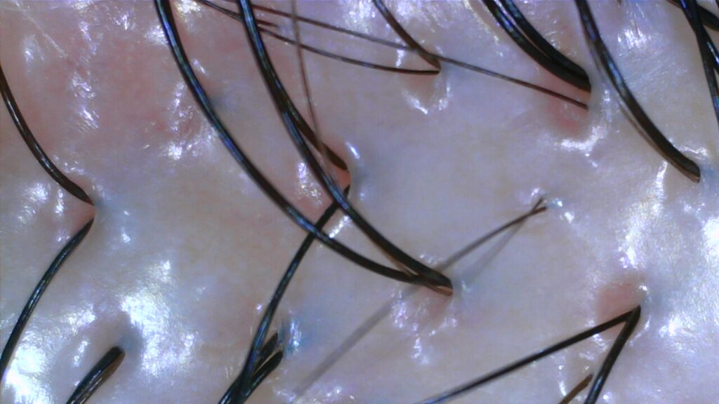 Oily scalp after
