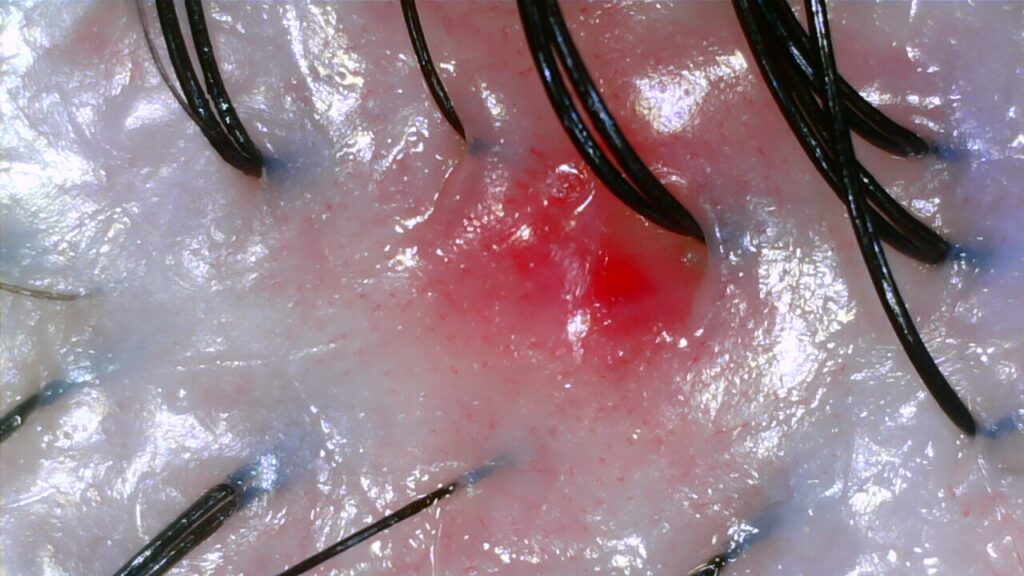 Scalp after dandruff treatment at NŌMI Head Spa