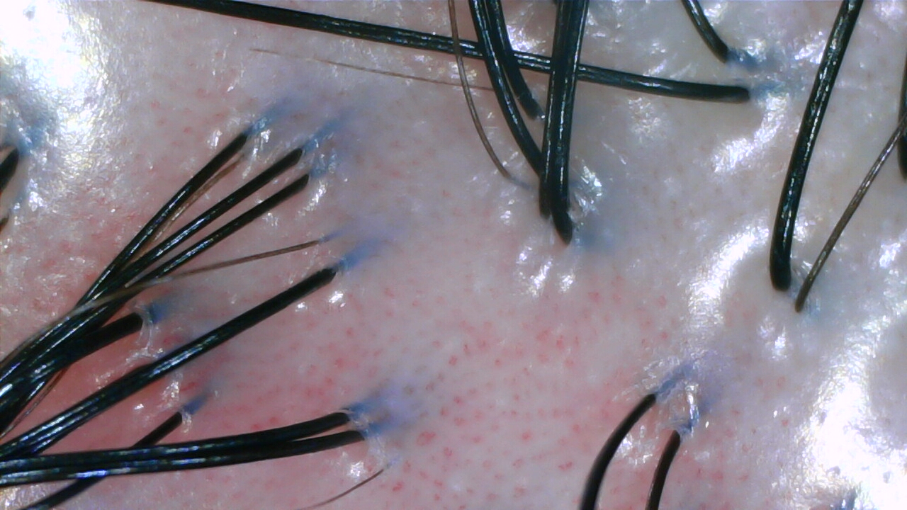 Scalp density improvement after Fuyu hair loss treatment at NŌMI