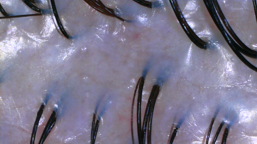 Scalp tension after