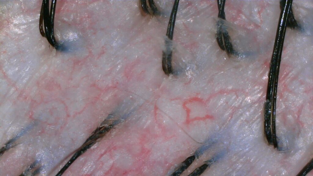 Scalp tension before