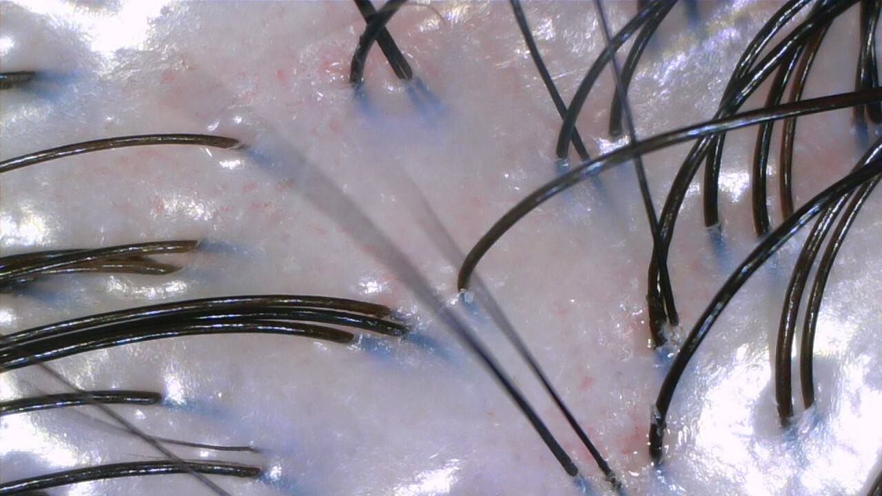 Scalp after dandruff treatment at NŌMI Head Spa