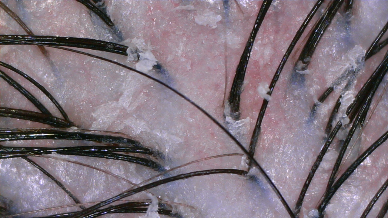 Sensitive and flaky scalp before NŌMI treatment