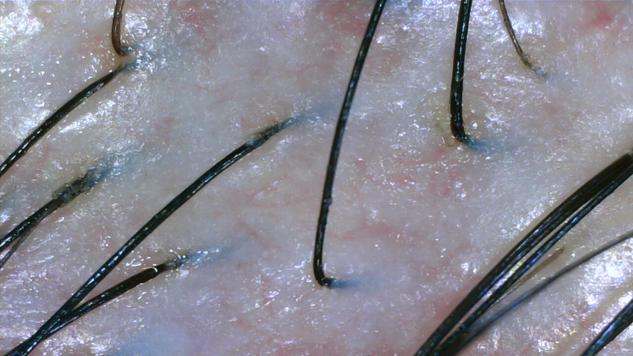 Hair thinning scalp before Fuyu treatment at NŌMI Bukit Jalil