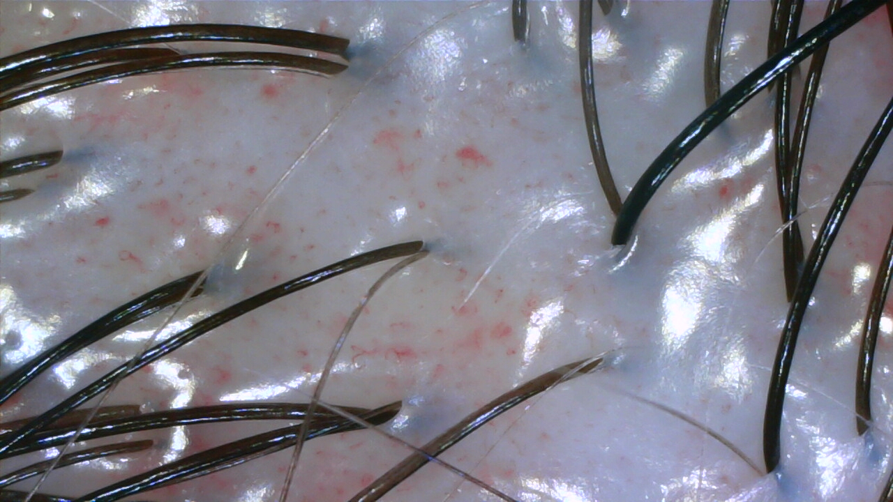 Dandruff scalp after treatment at NŌMI