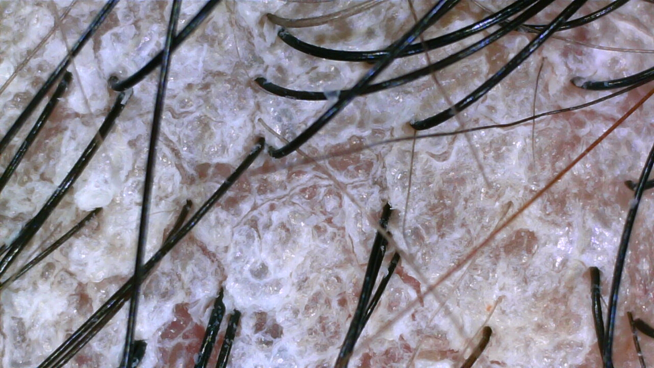 Dandruff scalp before treatment at NŌMI