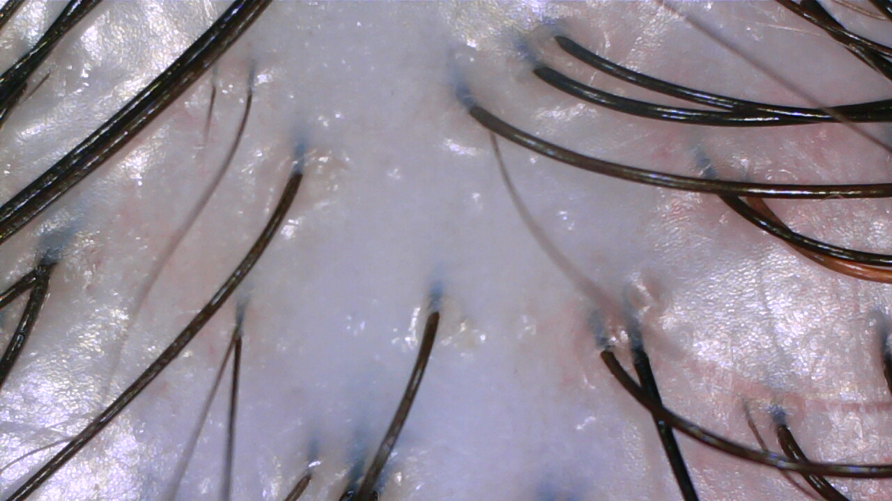 Scalp density improvement after Fuyu hair loss treatment at NŌMI