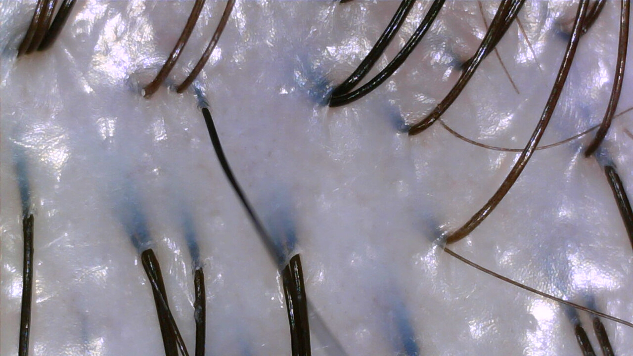 Oily scalp after