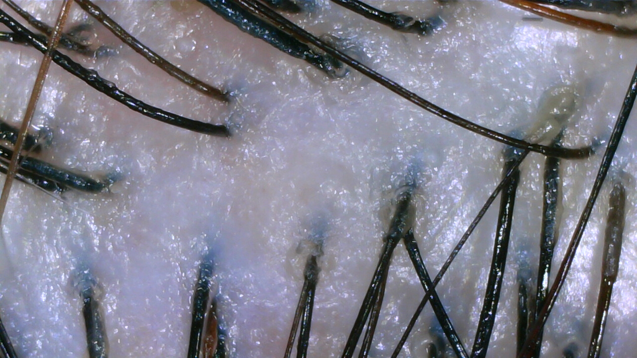 Oily scalp before