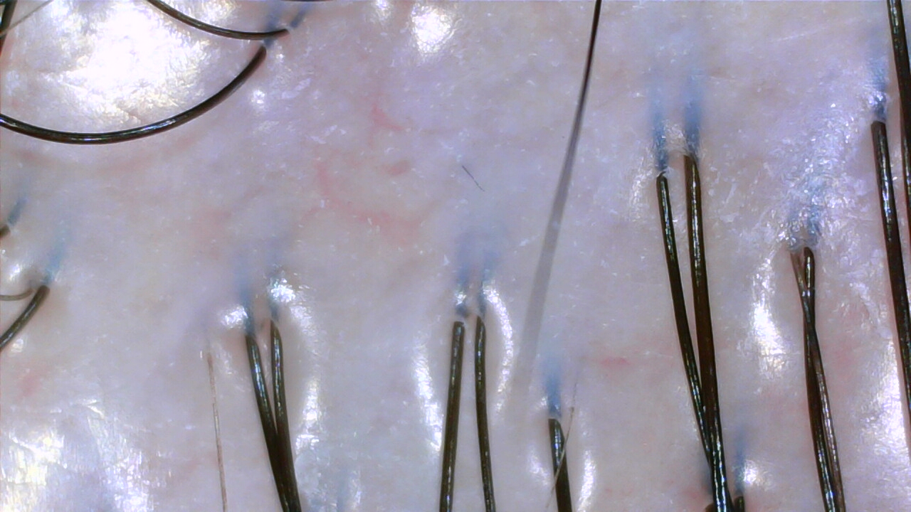 Oily scalp after