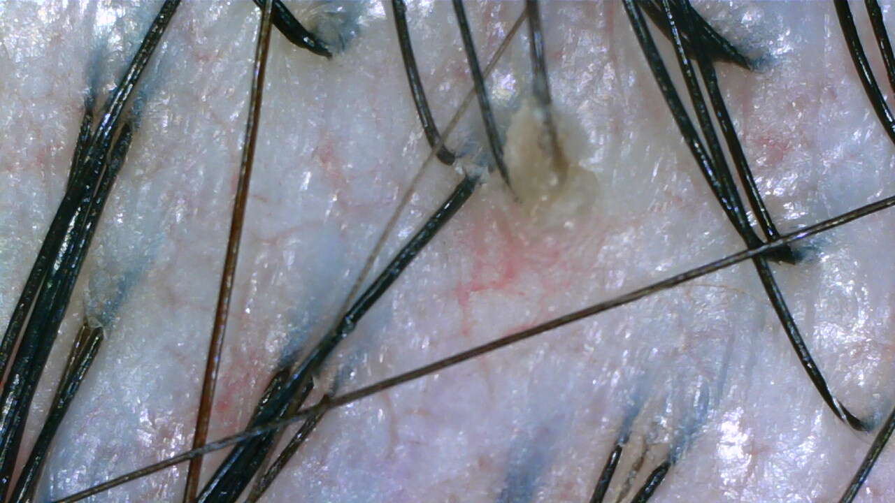Oily scalp before