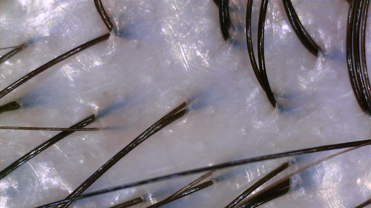 Sensitive scalp after treatment at NŌMI, Bukit Jalil