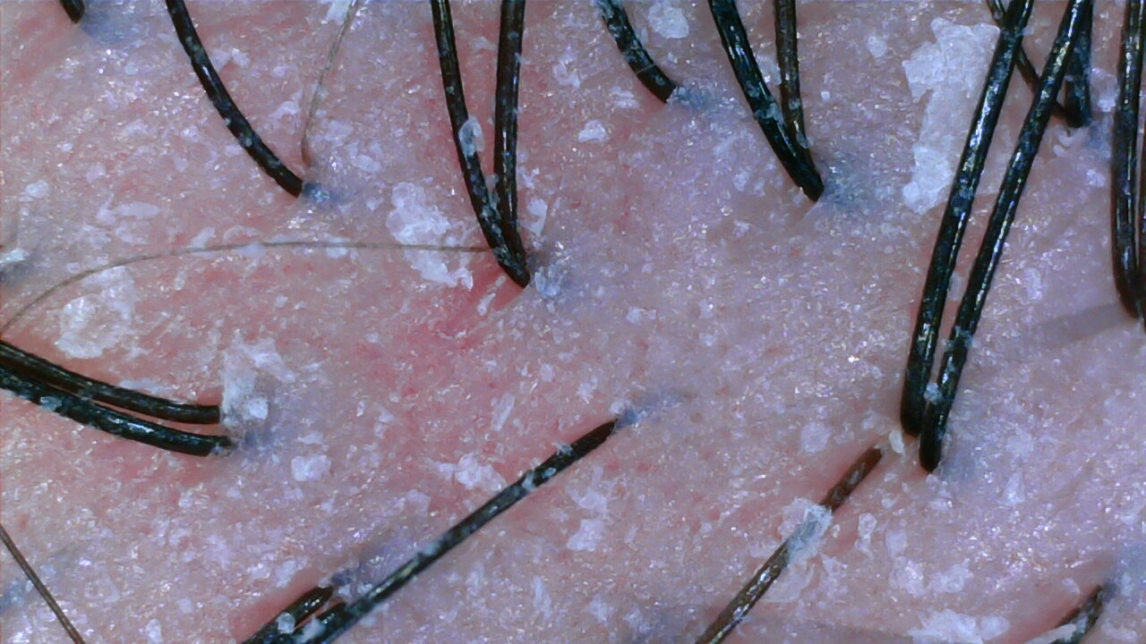 Sensitive scalp before treatment at NŌMI